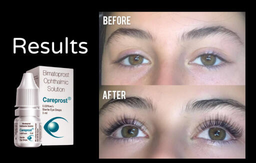 Careprost is an ophthalmic solution of bimatoprost that helps within 12-14 weeks to get longer, thicker & darker eyelashes.

Buy Now: https://genericaura.com/product/careprost-eye-drops/