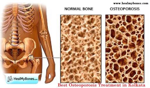 Osteoporosis is inevitable as we age. Dr. Manoj Kumar Khemani is a highly qualified and experienced orthopaedic who offers treatment for osteoporosis. Know more https://www.healmybones.com/articles/osteoporosis/osteoporosis-myths.php